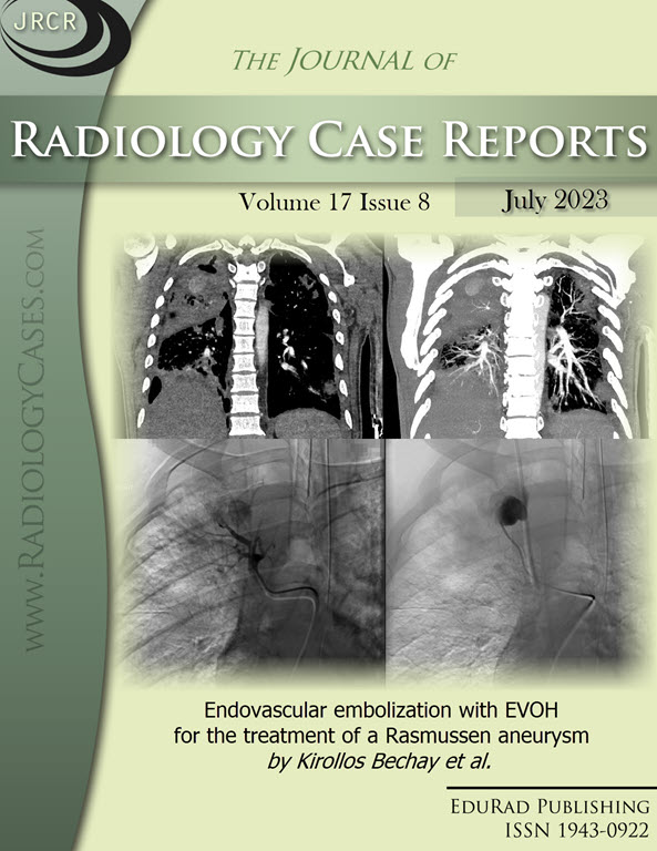 Journal of Radiology Case Reports August 2023 issue cover page: Endovascular embolization with EVOH for the treatment of a Rasmussen aneurysm by Kirollos Bechay et al.