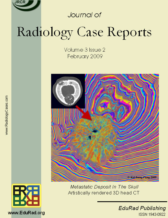 Journal cover page: Metastatic Deposit In The Skull