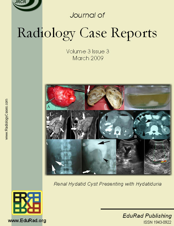 Renal Hydatid Cyst Presenting with Hydatiduria