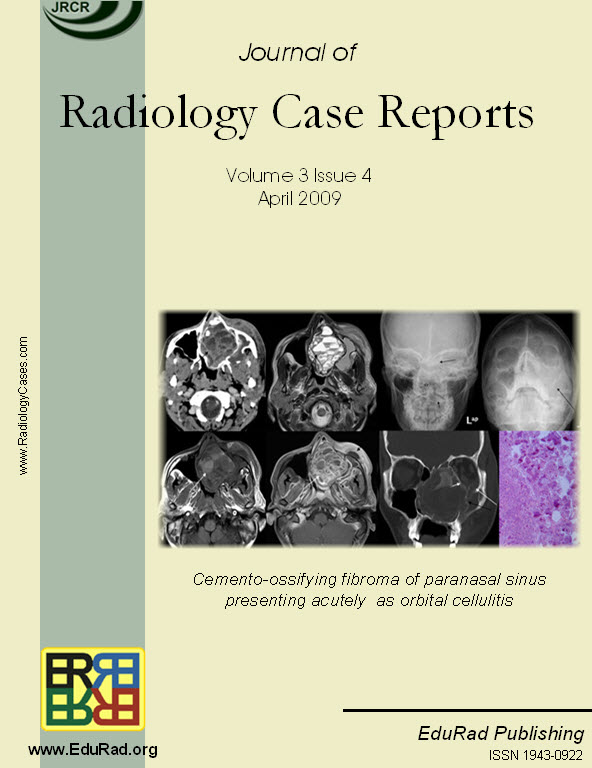 Cover page of the April 2009 issue. Cemento-ossifying fibroma of paranasal sinus presenting acutely  as orbital cellulitis by Maneesh Khanna.