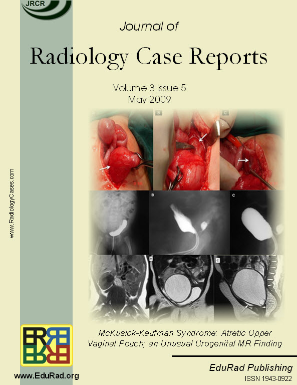 McKusick-Kaufman Syndrome: Atretic Upper Vaginal Pouch; an Unusual Urogenital MR Finding