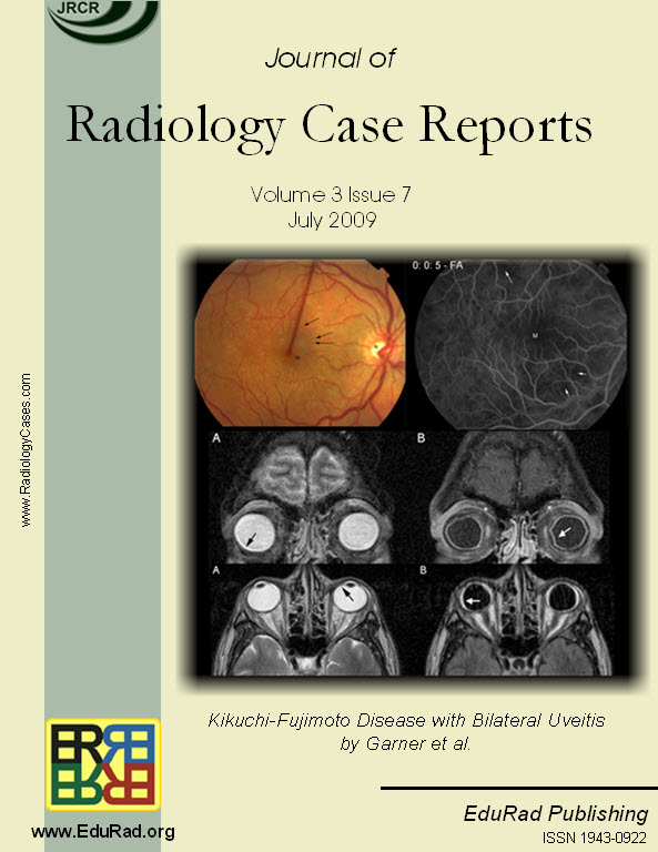Journal of Radiology Case Reports July 2009 issue - Cover page: Kikuchi-Fujimoto Disease with Bilateral Uveitis by Garner et al.