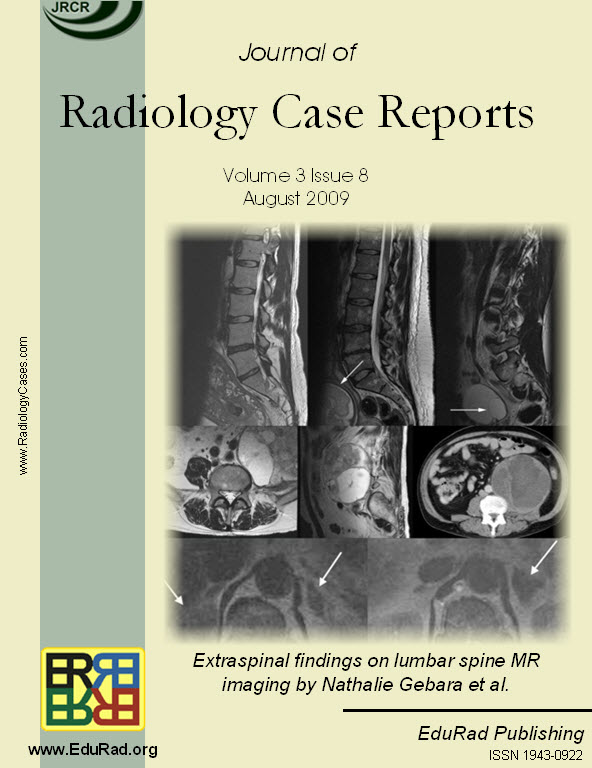 Review article: Extraspinal findings on lumbar spine MR imaging by Nathalie Gebara et al.