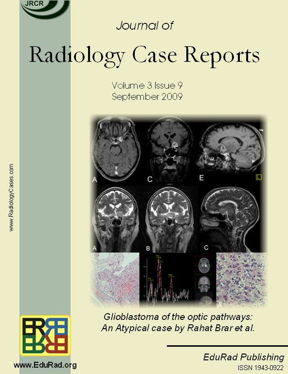 Glioblastoma of the optic pathways: An Atypical case by Rahat Brar et al.