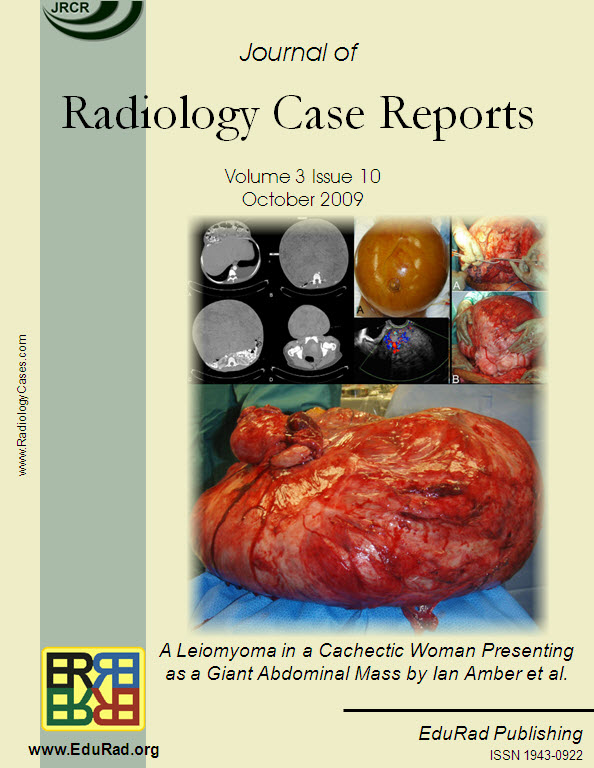 A Leiomyoma in a Cachectic Woman Presenting as a Giant Abdominal Mass by Iam Amber et al.