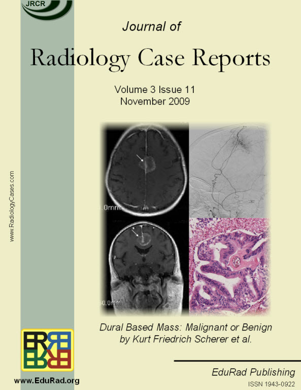 Journal of Radiology Case Reports November 2009 issue cover page: Dural Based Mass: Malignant or Benign by Kurt Friedrich Scherer et al.