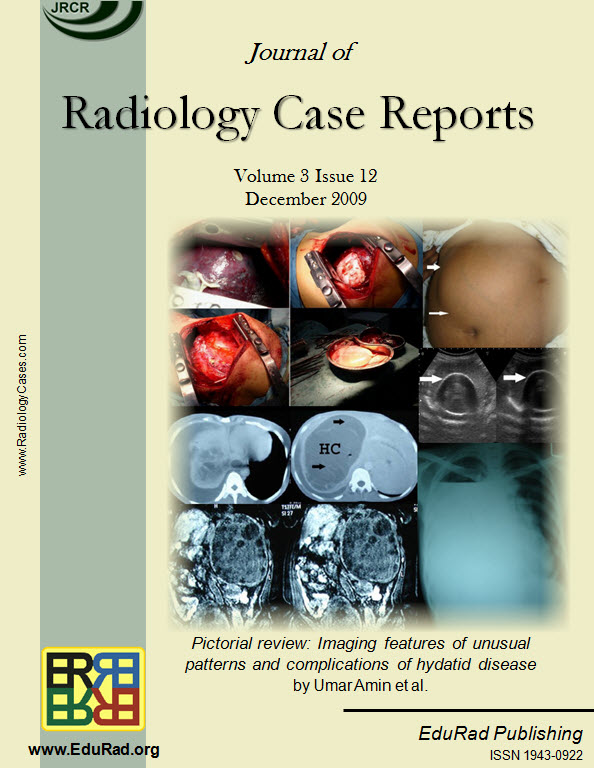 Pictorial review: Imaging features of unusual patterns and complications of hydatid disease by Umar Amin et al.