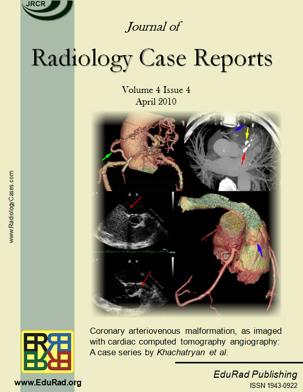 Coronary arteriovenous malformation, as imaged with cardiac computed tomography angiography: A case series by Khachatryan et al.