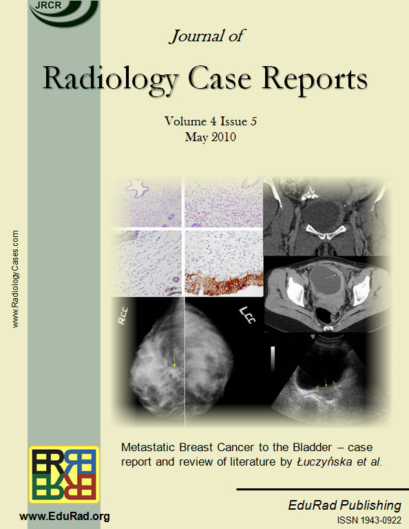 Journal of Radiology Case Reports May 2010 issue cover page: "Metastatic Breast Cancer to the Bladder – case report and review of literature" by ÅuczyÅ„ska et al.