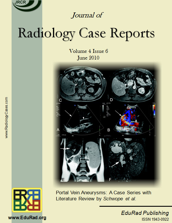 Journal of Radiology Case Reports June 2010 issue cover page: Portal Vein Aneurysms: A Case Series with Literature Review by Schwope et al.