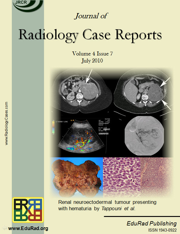 Journal of Radiology Case Reports July 2010 issue. Renal neuroectodermal tumour presenting with hematuria by Tappouni et al.