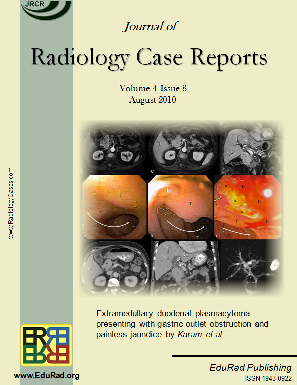 Extramedullary duodenal plasmacytoma presenting with gastric outlet obstruction and painless jaundice by Karam et al.