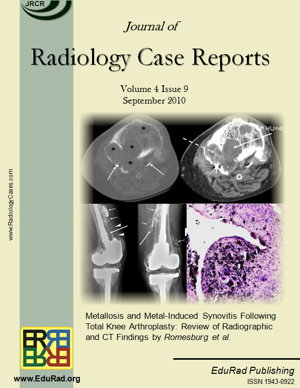Metallosis and Metal-Induced Synovitis Following Total Knee Arthroplasty: Review of Radiographic and CT Findings by Romesburg et al.