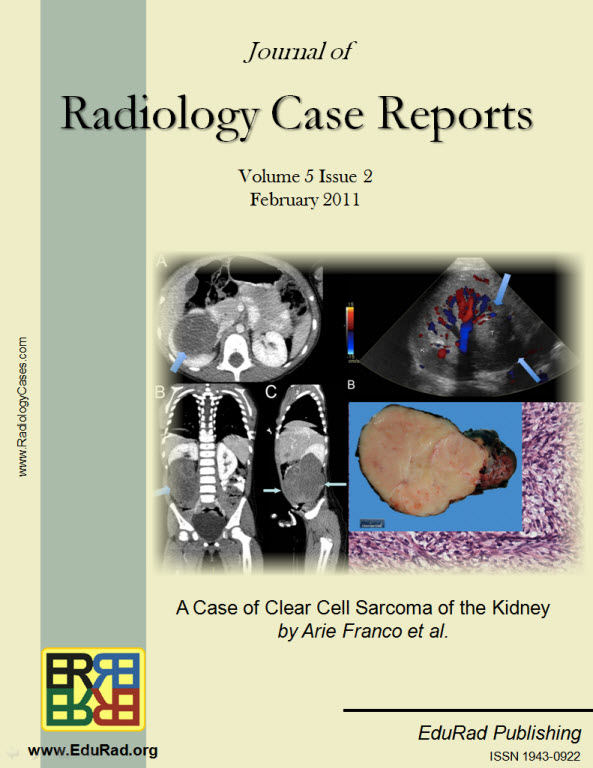 Journal of Radiology Case Reports February 2011 issue - A Case of Clear Cell Sarcoma of the Kidney by Arie Franco et al.