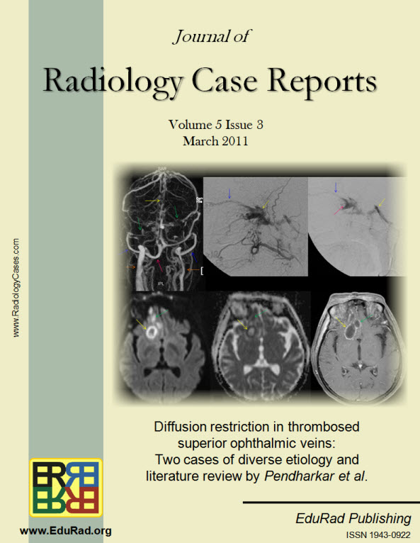 Diffusion restriction in thrombosed superior ophthalmic veins: Two cases of diverse etiology and literature review by Pendharkar et al.