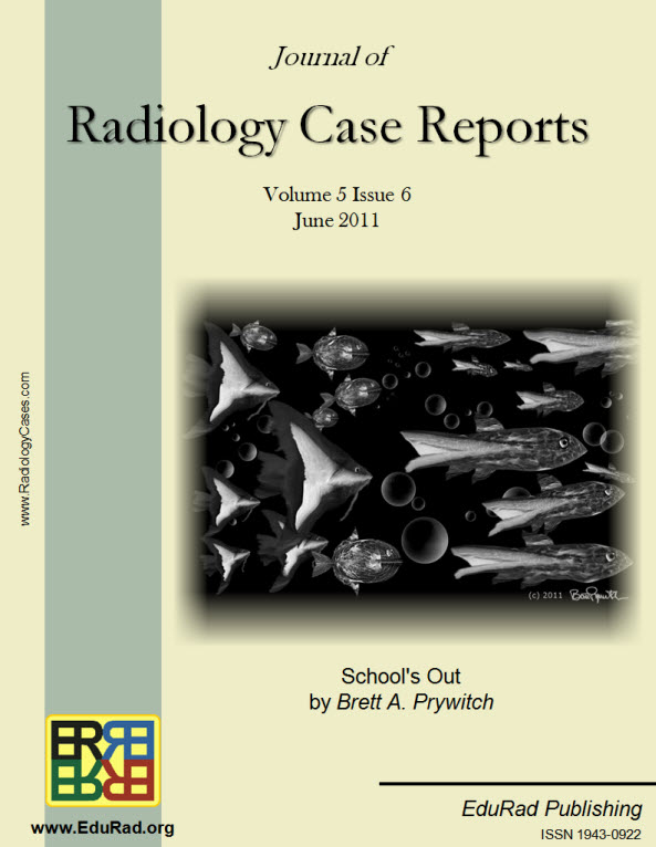 Journal of Radiology Case Reports June 2011 issue - "School's Out" by Brett A. Prywitch