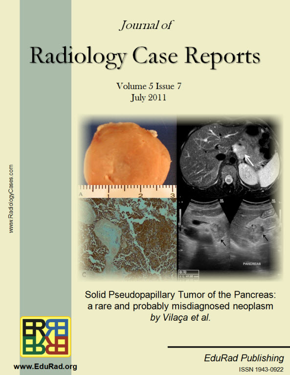 Journal of Radiology Case Reports July 2011 issue - "Solid Pseudopapillary Tumor of the Pancreas: a rare and probably misdiagnosed neoplasm" by Vilaça et al.