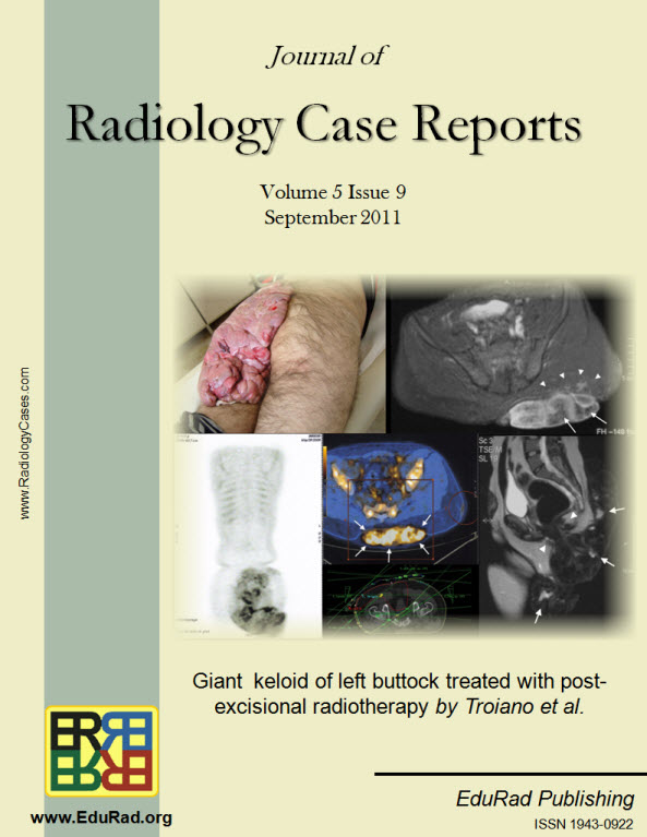 Journal of Radiology Case Reports September 2011 issue - Giant  keloid of left buttock treated with post-excisional radiotherapy by Troiano et al.