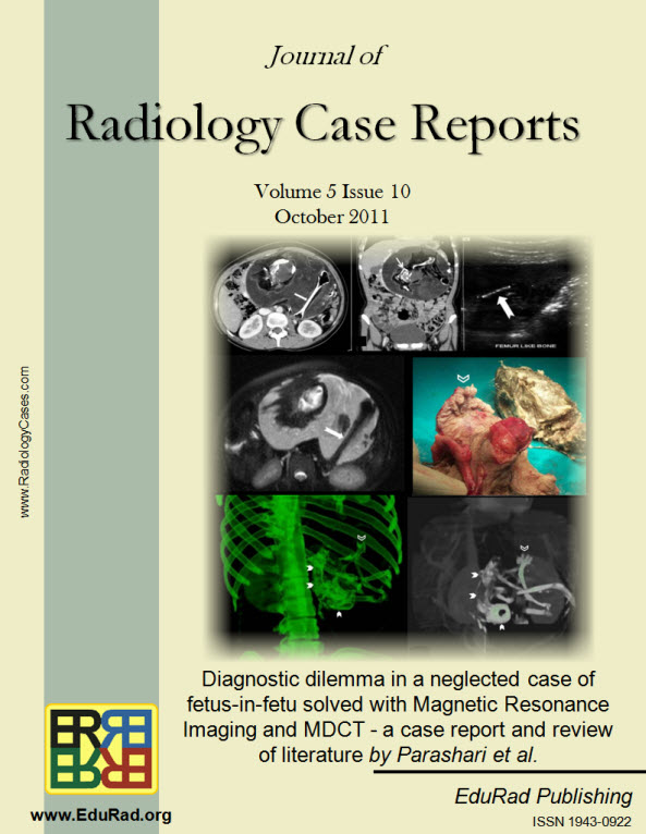 Journal of Radiology Case Reports October 2011 issue - Diagnostic dilemma in a neglected case of fetus-in-fetu solved with Magnetic Resonance Imaging and MDCT - a case report and review of literature by Parashari et al.