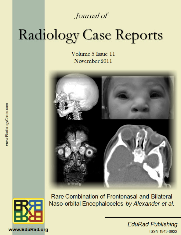 Journal of Radiology Case Reports November 2011 issue - Rare Combination of Frontonasal and Bilateral Naso-orbital Encephaloceles by Alexander et al.