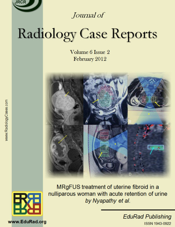 Journal of Radiology Case Reports February 2012 issue - MRgFUS treatment of uterine fibroid in a nulliparous woman with acute retention of urine by Nyapathy et al.