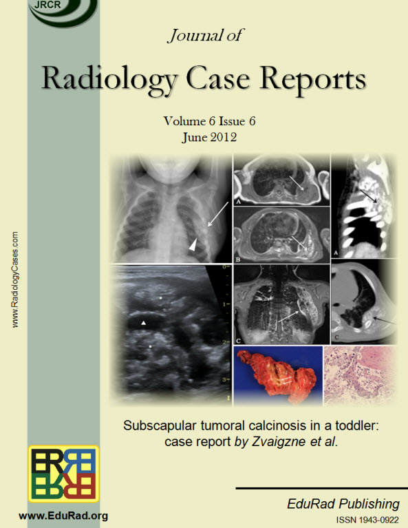 Journal of Radiology Case Reports June 2012 issue - Subscapular tumoral calcinosis in a toddler: case report by Zvaigzne et al.