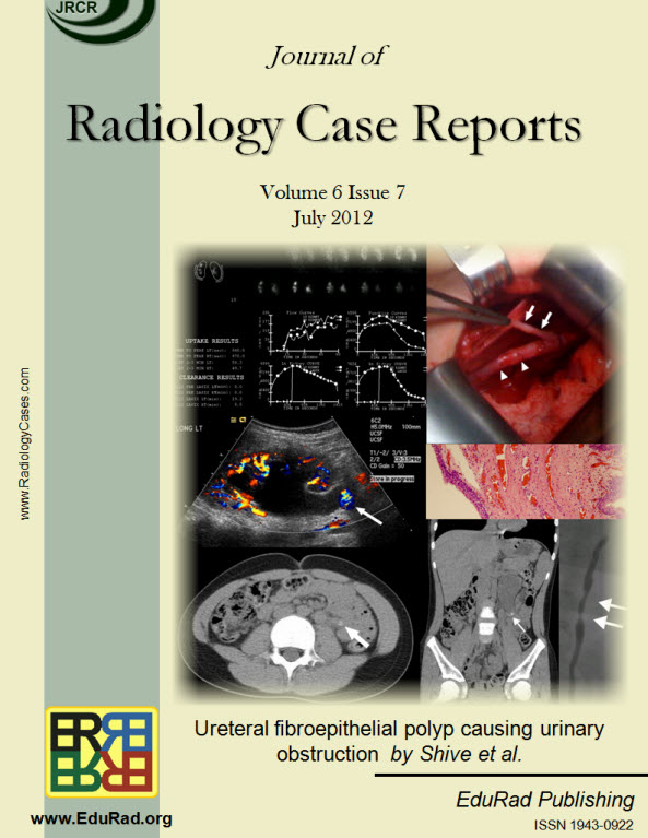 Journal of Radiology Case Reports July 2012 issue - Ureteral fibroepithelial polyp causing urinary obstruction by Shive et al.