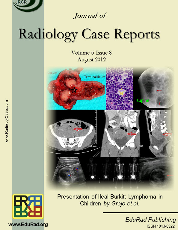 Journal of Radiology Case Reports August 2012 issue - Presentation of Ileal Burkitt Lymphoma in Children by Grajo et al.