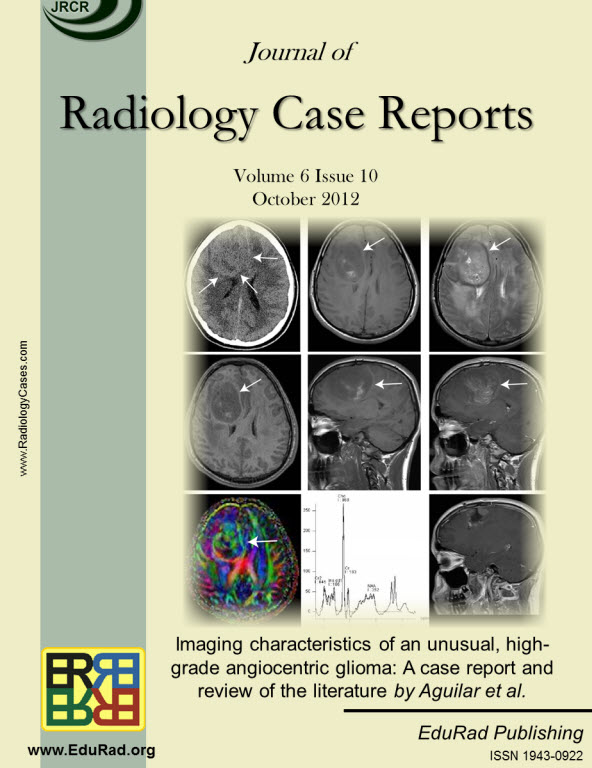 Journal of Radiology Case Reports October 2012 issue - Imaging characteristics of an unusual, high-grade angiocentric glioma: A case report and review of the literature by Aguilar et al
