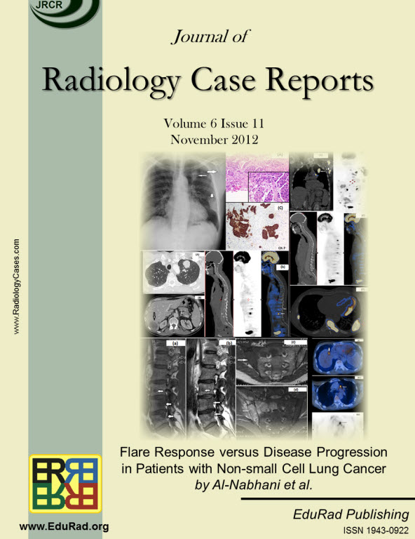 Journal of Radiology Case Reports November 2012 issue - Flare Response versus Disease Progression in Patients with Non-small Cell Lung Cancer by Al-Nabhani et al.