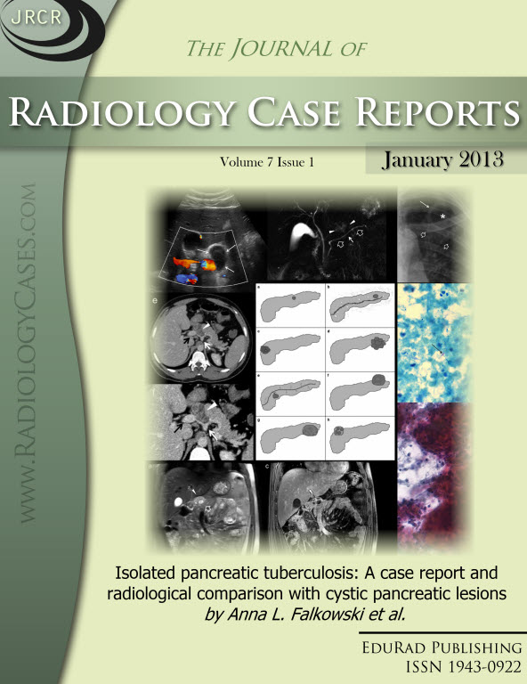 Journal of Radiology Case Reports January 2013 issue - Isolated pancreatic tuberculosis: A case report and radiological comparison with cystic pancreatic lesions by Anna L. Falkowski et al.