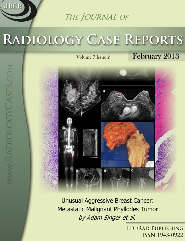 Journal of Radiology Case Reports February 2013 issue - Cover page: Unusual Aggressive Breast Cancer: Metastatic Malignant Phyllodes Tumor by Adam Singer et al.