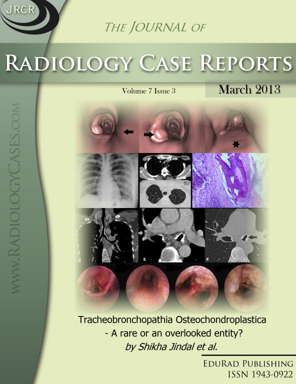 Journal of Radiology Case Reports March 2013 issue - Cover page: Tracheobronchopathia Osteochondroplastica - A rare or an overlooked entity? by Shikha Jindal et al.