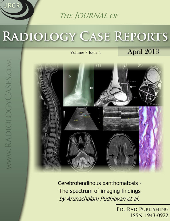 Journal of Radiology Case Reports April 2013 issue - Cover page: Cerebrotendinous xanthomatosis - The spectrum of imaging findings by Arunachalam Pudhiavan et al.