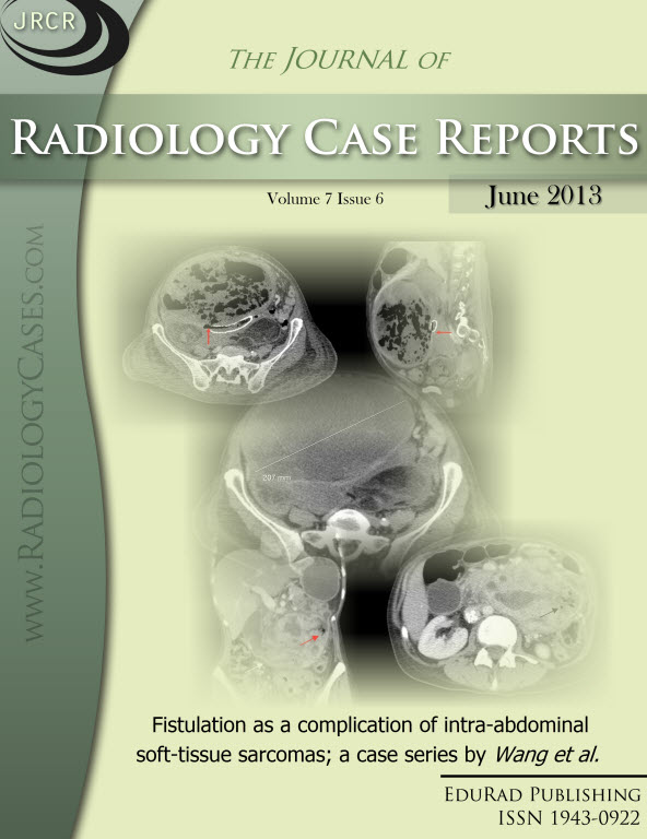 Journal of Radiology Case Reports June 2013 issue - Cover page: Fistulation as a complication of intra-abdominal soft-tissue sarcomas; a case series by Wang et al.