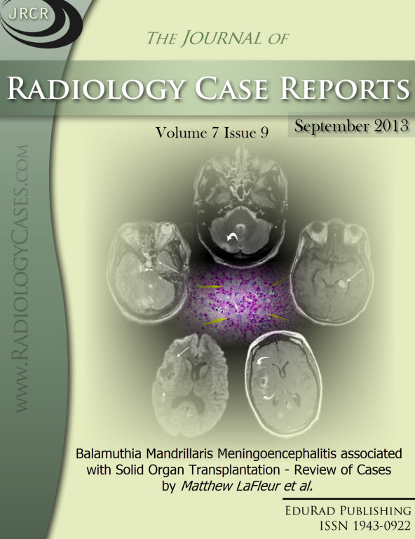 Journal of Radiology Case Reports September 2013 issue - Cover page: Balamuthia Mandrillaris Meningoencephalitis associated with Solid Organ Transplantation - Review of Cases by Matthew LaFleur et al.