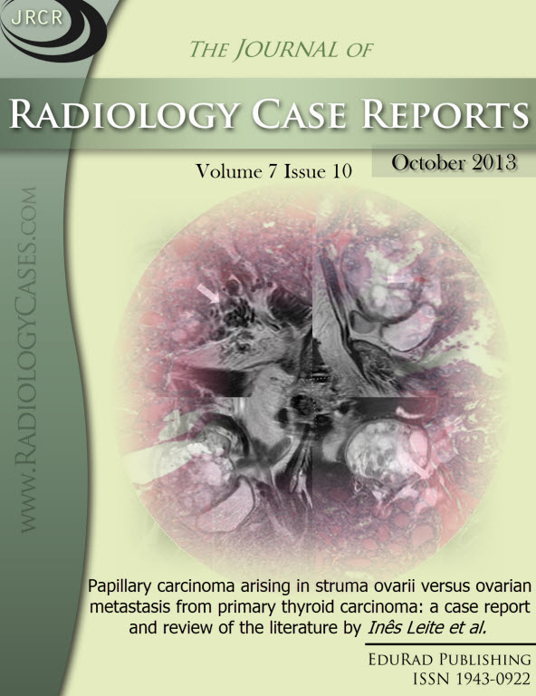 Journal of Radiology Case Reports October 2013 issue - Cover page: Papillary carcinoma arising in struma ovarii versus ovarian metastasis from primary thyroid carcinoma: a case report and review of the literature by Iníªs Leite et al.