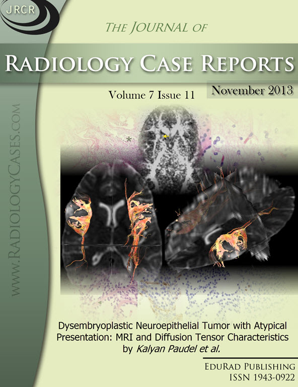 Journal of Radiology Case Reports November 2013 issue - Cover page: Dysembryoplastic Neuroepithelial Tumor with Atypical Presentation: MRI and Diffusion Tensor Characteristics by Paudel et at.