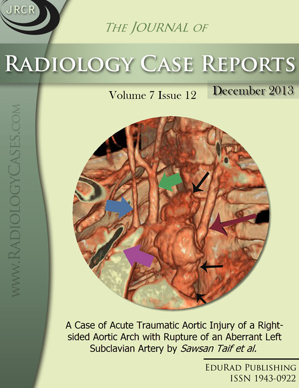 Journal of Radiology Case Reports December 2013 issue - Cover page: A Case of Acute Traumatic Aortic Injury of a Right-sided Aortic Arch with Rupture of an Aberrant Left Subclavian Artery by Sawsan Taif et al.