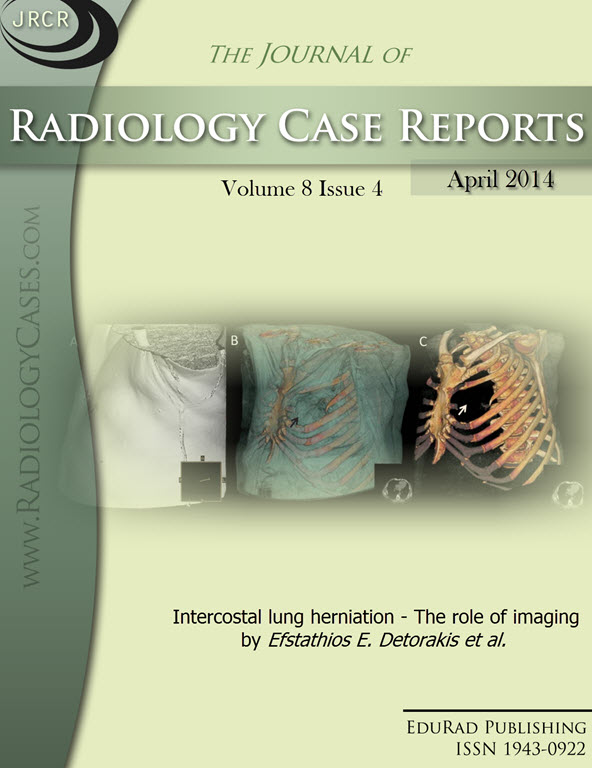 Journal of Radiology Case Reports April 2014 issue - Cover page: Intercostal lung herniation - The role of imaging by Efstathios E. Detorakis et al.
