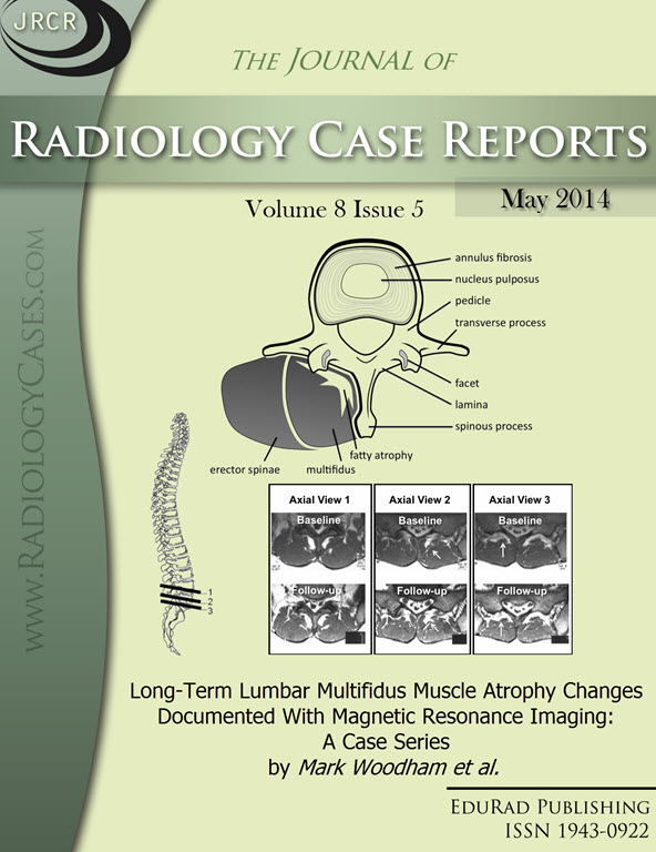 Journal of Radiology Case Reports May 2014 issue - Cover page: Long-Term Lumbar Multifidus Muscle Atrophy Changes Documented With Magnetic Resonance Imaging: A Case Series by Mark Woodham et al.