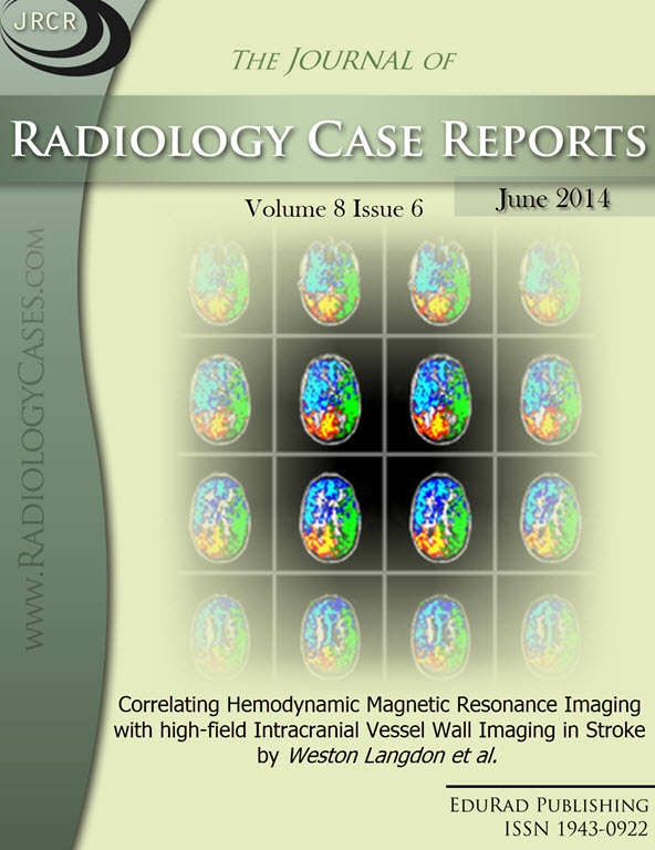 Journal of Radiology Case Reports June 2014 issue - Cover page: Correlating Hemodynamic Magnetic Resonance Imaging with high-field Intracranial Vessel Wall Imaging in Stroke by Weston Langdon et al.