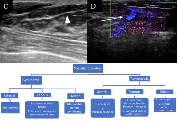 Venous Malformation in the Breast: Imaging Features to Avoid Unnecessary Biopsies or Surgery