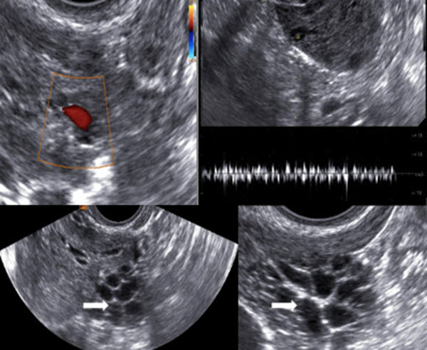 Real time ultrasound diagnosis of ovarian and pelvic filariasis by filarial dance sign