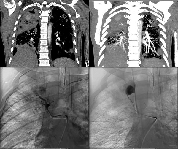 Endovascular embolization with EVOH for the treatment of a Rasmussen aneurysm