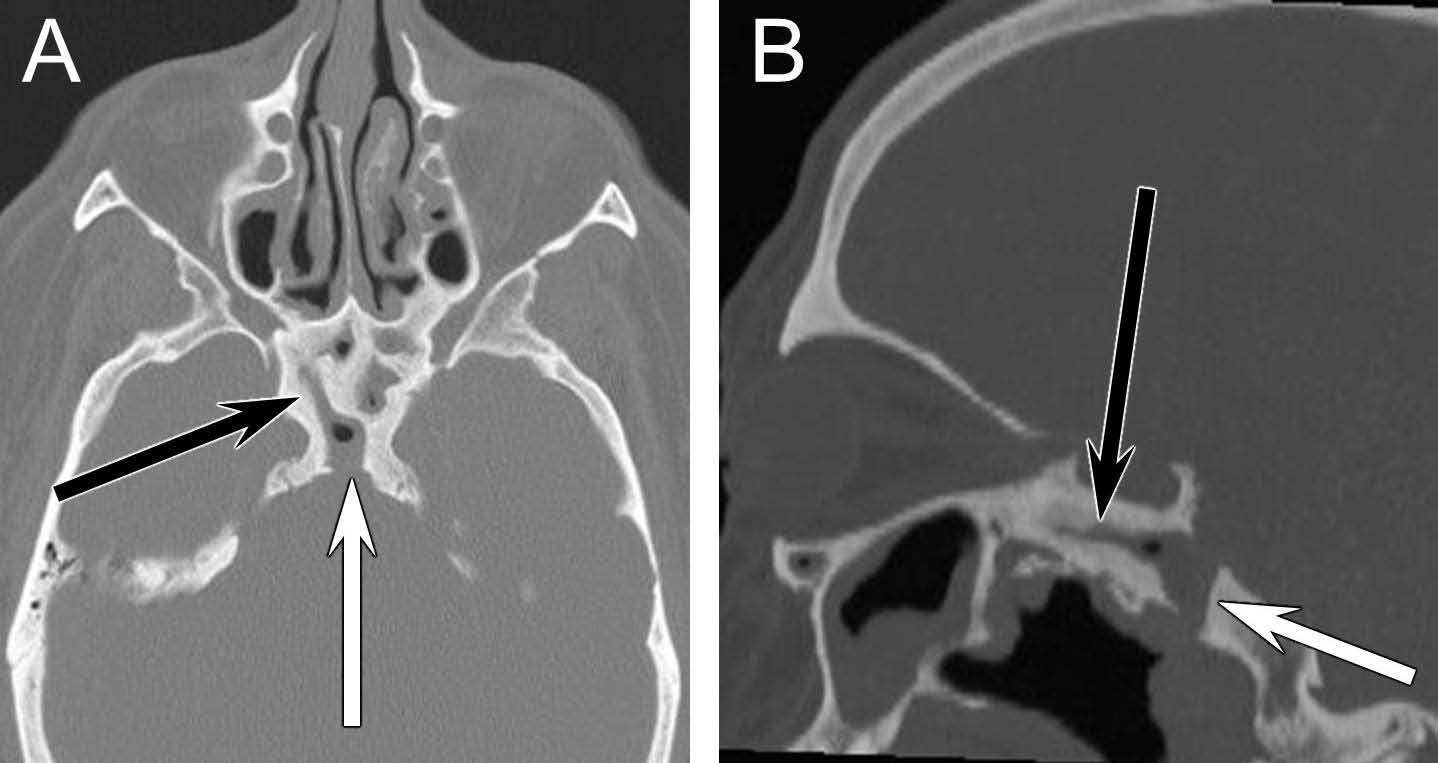 46-year-old man with persistent craniopharyngeal canal and an associated sphenoid sinus fistula.