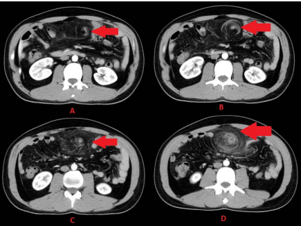 32 year old male with omental torsion secondary to left sided inguinal hernia