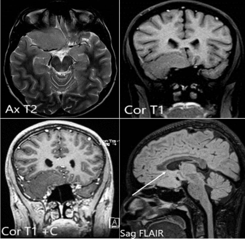 A 15-year-old boy, with Sublobar dysplasia