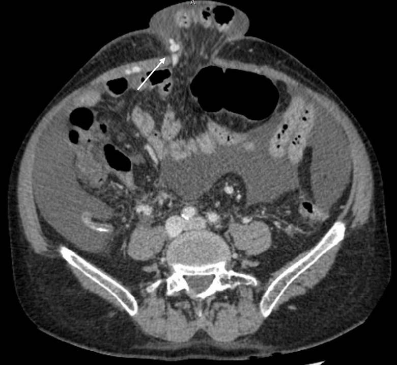 56-year-old man with Flood Syndrome