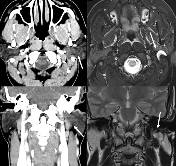 Intra-parotid facial nerve neuroma, an overlooked differential for a parotid lesion